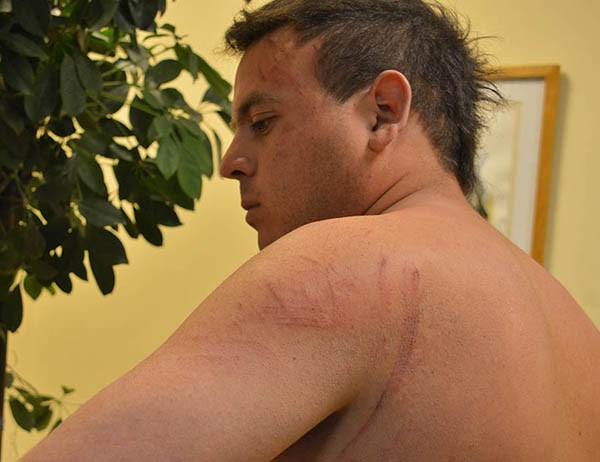 Huellas. Hernández mostró las lesiones en varias partes del cuerpo.