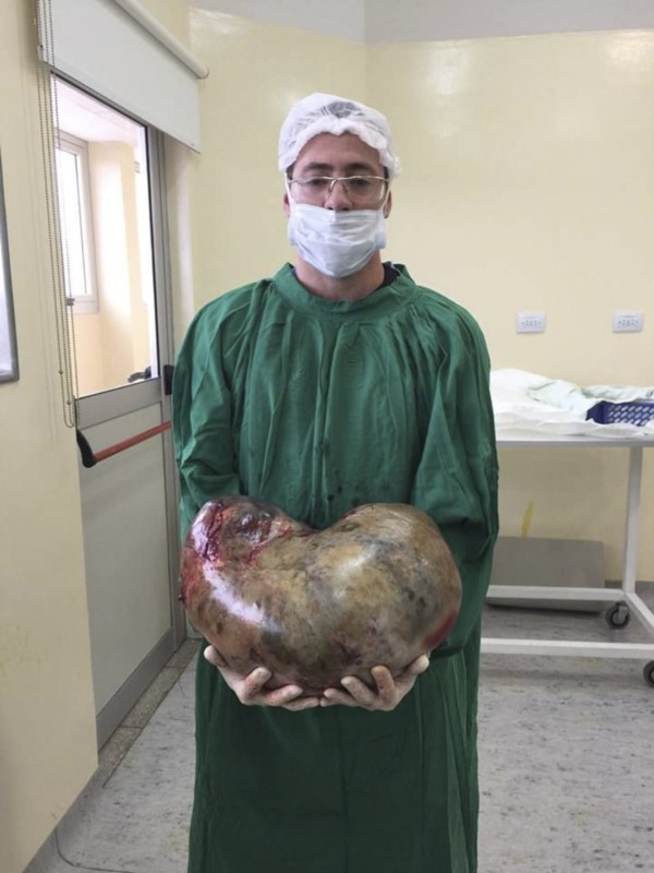 "El peso del tumor era un tercio del peso de la paciente. El tumor comprometía todo el abdomen y la pelvis".