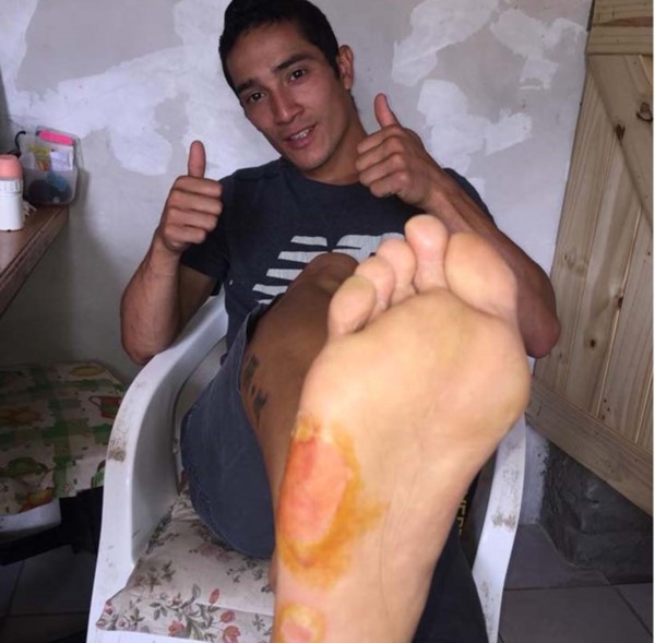 Enormes ampollas le quedaron en el pie derecho a Arbe tras el triunfo.