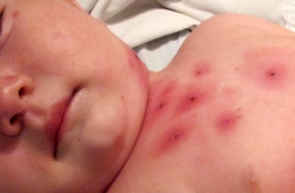 Una madre que no creen en las vacunas adquirió la enfermedad y contagió a sus 5 hijos de entre 5 y 19 años de edad.