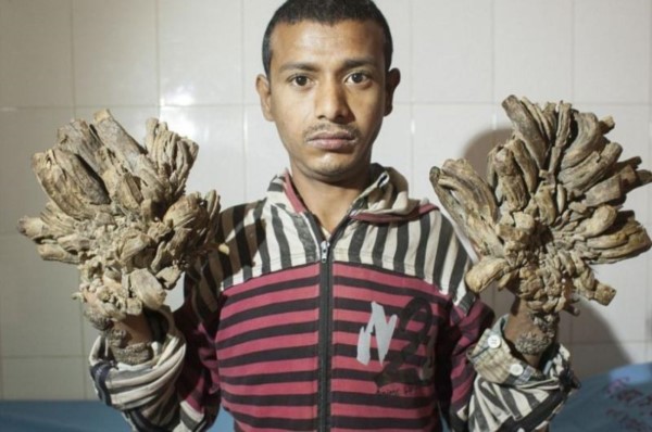 Abul Bajandar, de 28 años, sufre epidermodisplasia verruciforme.