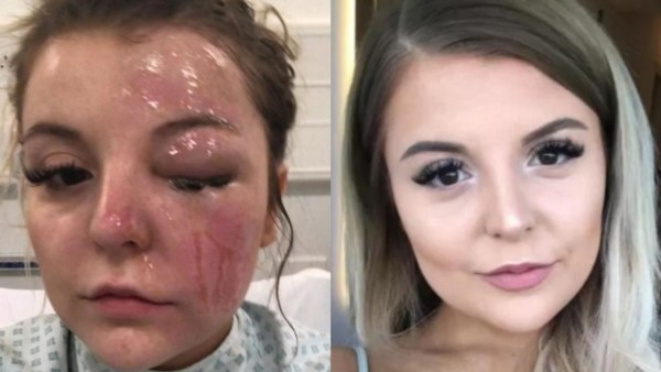 Bethany Rosser con el rostro desfigurado por un huevazo.