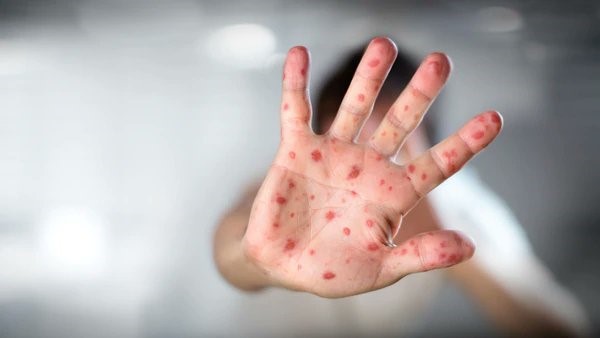 El sarampión es una de las enfermedades que más fácilmente se trasmite por vías respiratorias.