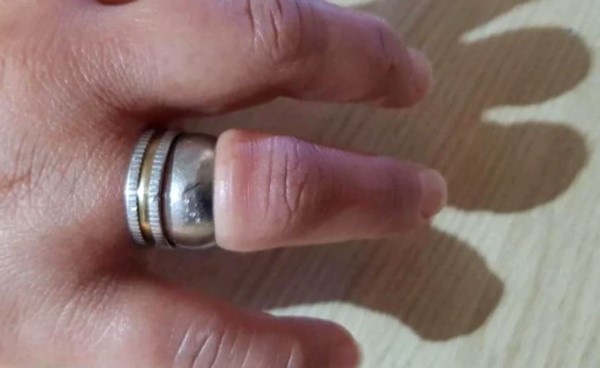 Al cabo de un rato, sumado a un arduo y delicado trabajo con herramientas, los bomberos lograron romper el anillo y así liberar el dedo de la mujer que ya estaba “muy inflamado”.